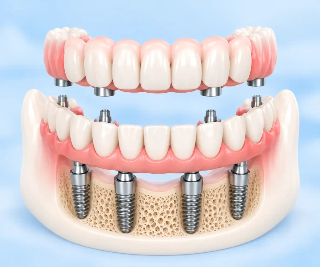 rize diş kliniği tam ağız implantı